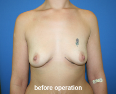 plastic-surgery-breast-augmentation